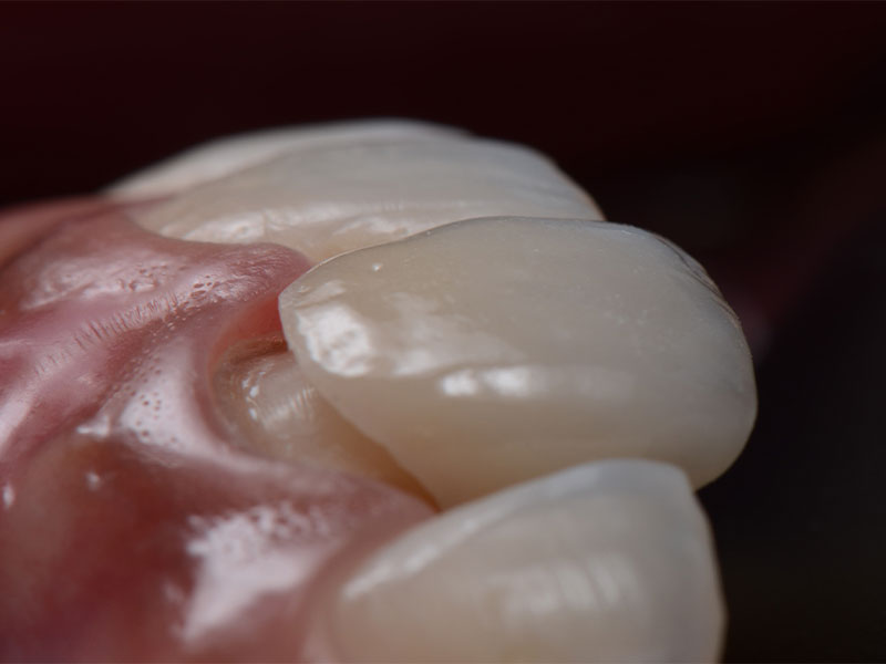 Faccette dentali preparazione faccette